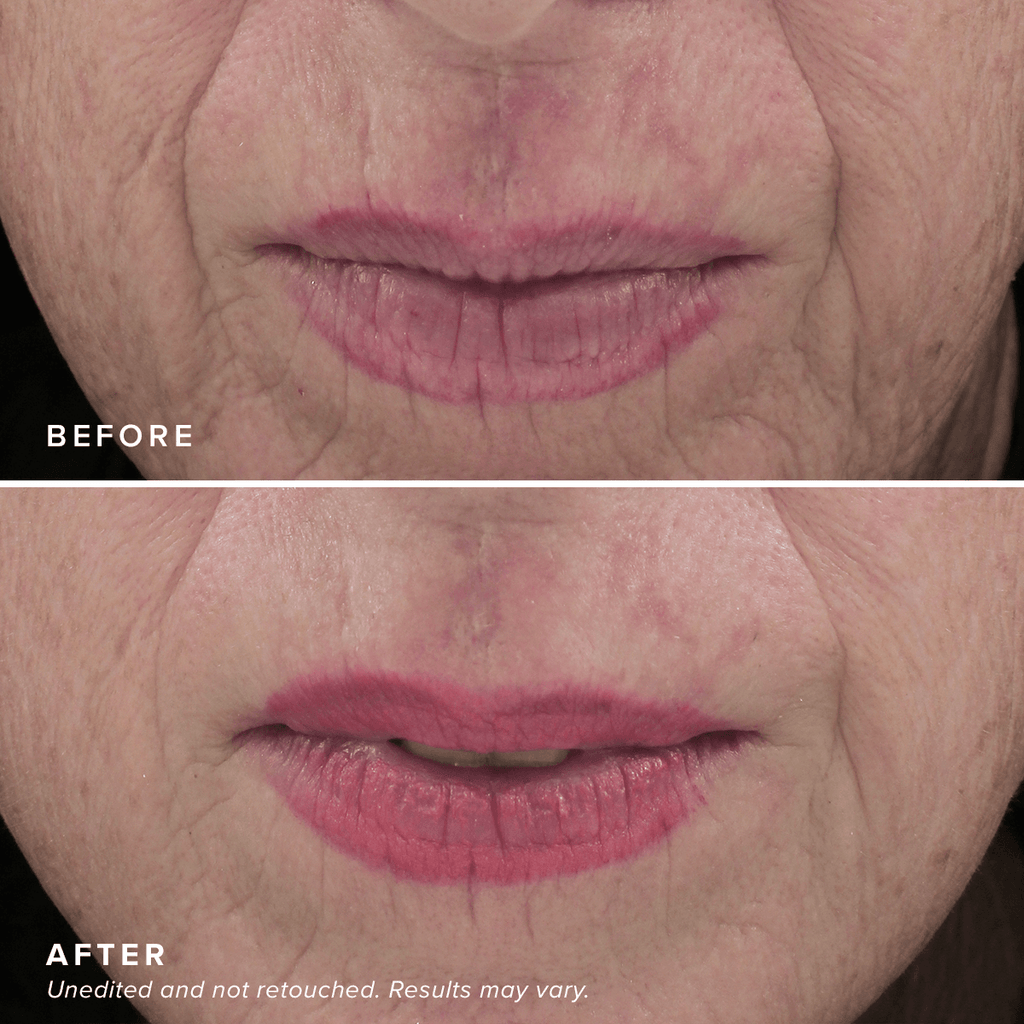 Needle-less® Serum
